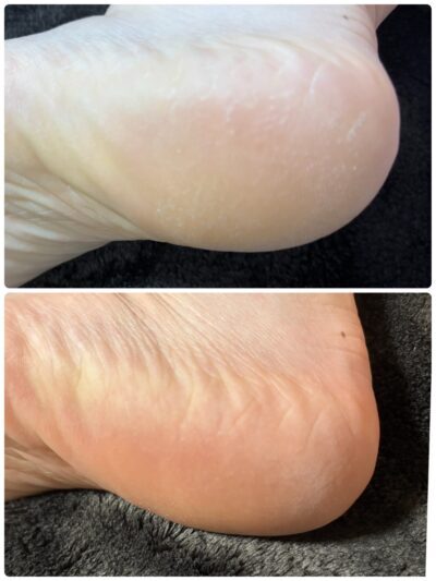 かかとのひび割れ